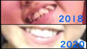 池田レイラの歯並びを時系列比較