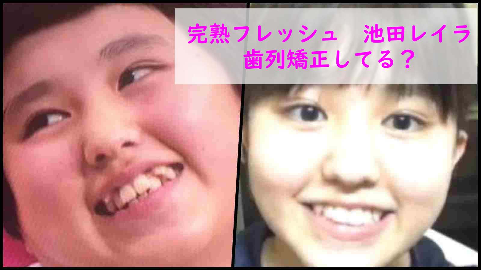 画像 池田レイラは歯列矯正した 歯並びの変化を時系列で比較してみた Noako Style